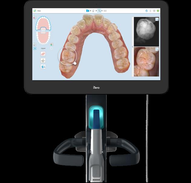 Ra mắt công nghệ quét dấu răng iTero 5D Plus - Ảnh 1.